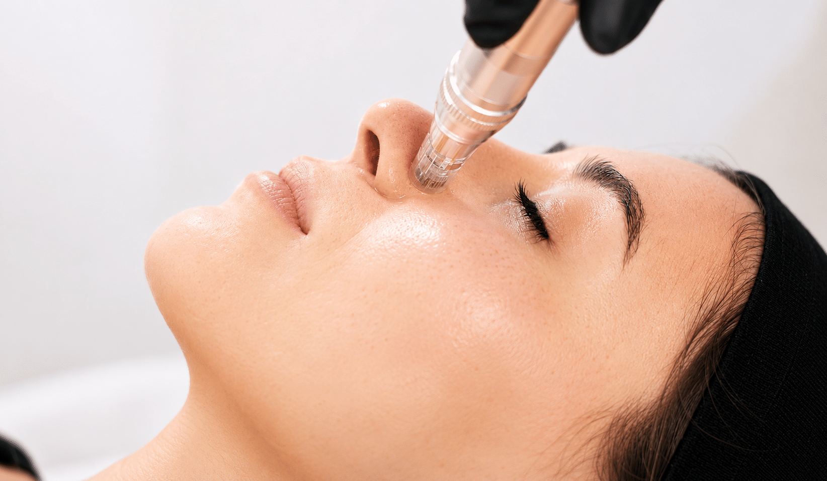 <b>Revitalisants</b> - Microneedling