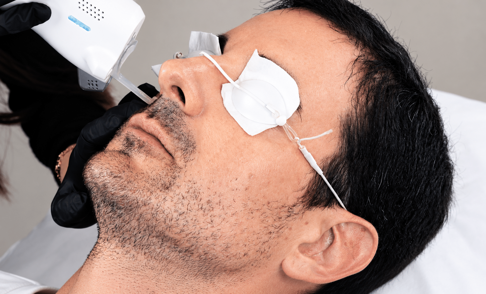 Laser Vasculaire